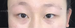 芭比平行双眼皮的日记有没有发出来看下？我表妹想在今年做！ width=