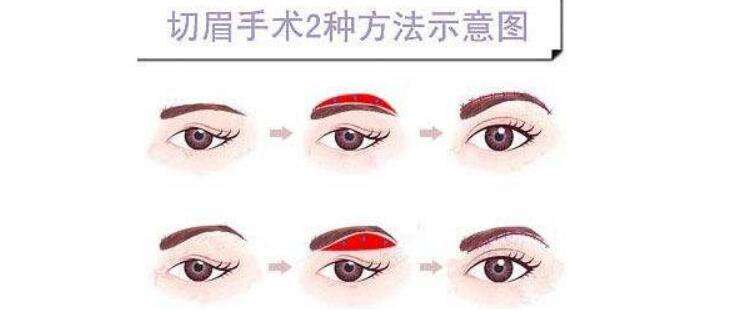 上眼皮松弛下垂该怎么办?如何保养?