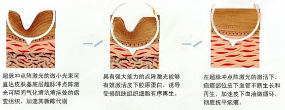 专家给你做科普--什么是点阵激光?