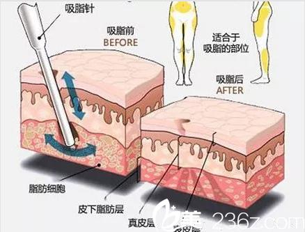 吸脂减肥手术大概多少钱?