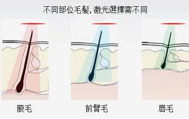 激光脱毛让你拥有光滑腿部