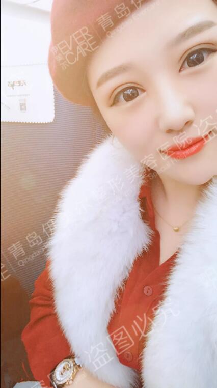 网红医生刘长发平行双眼皮+内眼角真实案例反馈 width=