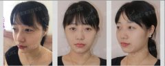 深圳美莱双眼皮+上睑下垂矫正55天真实案例对比图 width=