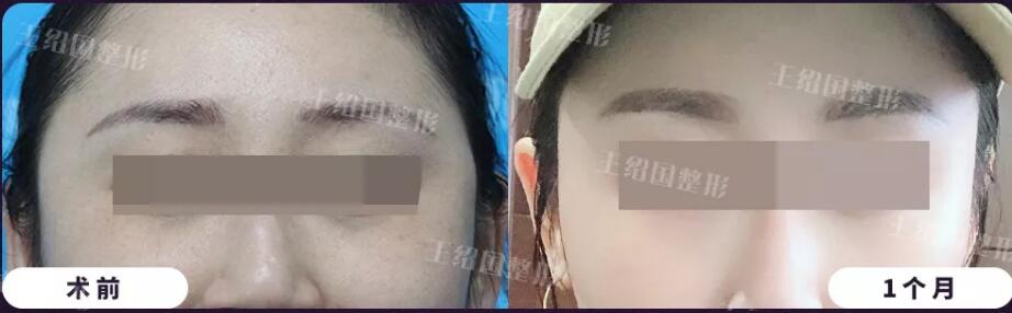 【共振技术只能用于吸脂吗？其实也可以取出！】