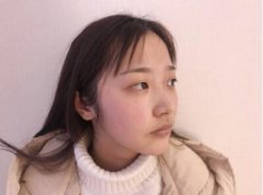 米兰柏羽胡书瀚双眼皮案例对比，这么好看的双眼皮! width=