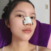 长春西之米整形价格表，膨体隆鼻案例分享! width=