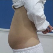 杭州格莱美整形崭新价格表，腹部吸脂案例分享! width=