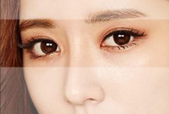 在沈阳杏林整容医院做埋线双眼皮果如何? width=