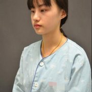 合肥壹加壹整形怎么样?——光纤溶脂瘦脸真人案例分享! width=