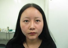 自贡西婵整形医院价目表——【面部吸脂案例分享大饼脸的自述】 width=