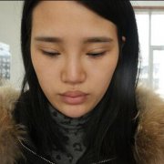 青岛华美整形医院价目表——【假体隆鼻案例恢复果分享】 width=