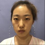 苏州康美自体脂肪填充面部凹陷真实恢复过程分享~ width=