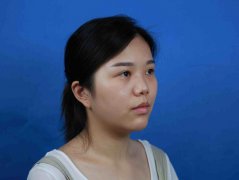 烟台鹏爱塌鼻子整形成为清流的案例日记 width=
