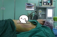 金华心艺张斌斌口碑怎么样?自体脂肪隆胸案例介绍 width=