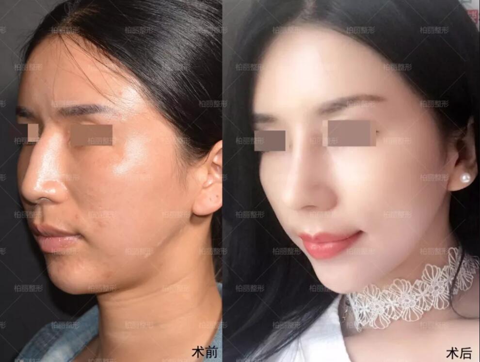 驼峰鼻多少钱已不是重点,驼峰鼻案例真人对比!