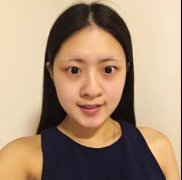 北京沃尔冯雁平怎么样?注射隆鼻果图案例介绍~ width=
