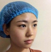 【丁小邦整形双眼皮案例】在丁小邦那割双眼皮一个月了。。 width=