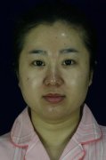 磨颧骨前后对比图案例，15天恢复果惊呆小伙伴..... width=
