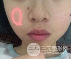 Q755激光祛伊藤痣后反黑怎么办?看我如何处理的!