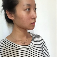 范巨峰的双眼皮好吗?首都医科大学附属北京朝阳医院真实案例为你解答
