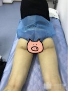 360度环形吸脂案例：50天扒光真实恢复过程~ width=