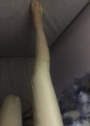 射频瘦小腿真实恢复对比案例，肌肉腿的消亡史 width=