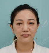 生物注射除皱真人案例：破除人生的“皱”折 width=