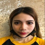 伊美尔健翔医院肋软骨隆鼻案例：为了隆鼻我花费了120天的时间恢复 width=