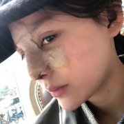 四川华人医联硅胶垫鼻梁两个月了，果较为不错看图 width=