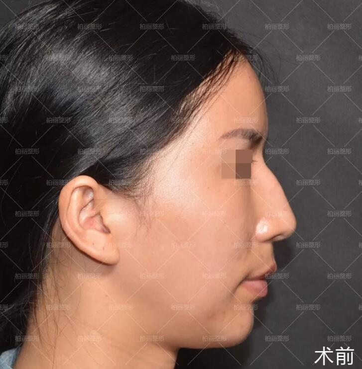 驼峰鼻多少钱喃？这则李劲良驼峰鼻矫正案例或许能告诉你！
