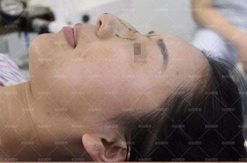 驼峰鼻多少钱喃？这则李劲良驼峰鼻矫正案例或许能告诉你！