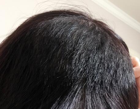 美人尖是什么样子的?来看看我的美人尖种植案例你就知道了