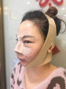 塌鼻子到水滴鼻的变化：我的水滴鼻恢复日记 width=
