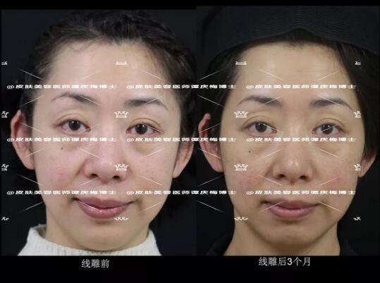 黄金埋线提升