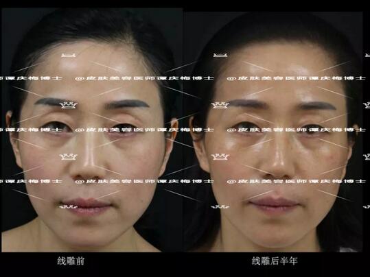黄金埋线提升