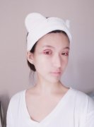 秦宏伟双眼皮案例分享：亲妈跟着一起做双眼皮的日子~ width=