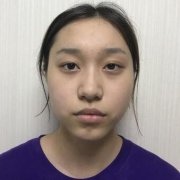 成都军大医院双眼皮手术40天，出落成一个好看的菇凉 width=