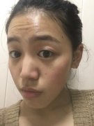 四川伊莎贝拉注射瘦脸去皱20天术后感想~ width=