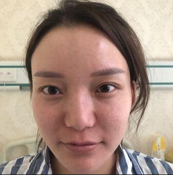 选择成都西区医院自体隆鼻手术纠结了我半个月