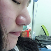 鼻骨缩窄手术多少钱?从此让你也能拥有一个鼻子