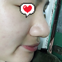 鼻骨缩窄手术多少钱?从此让你也能拥有一个鼻子