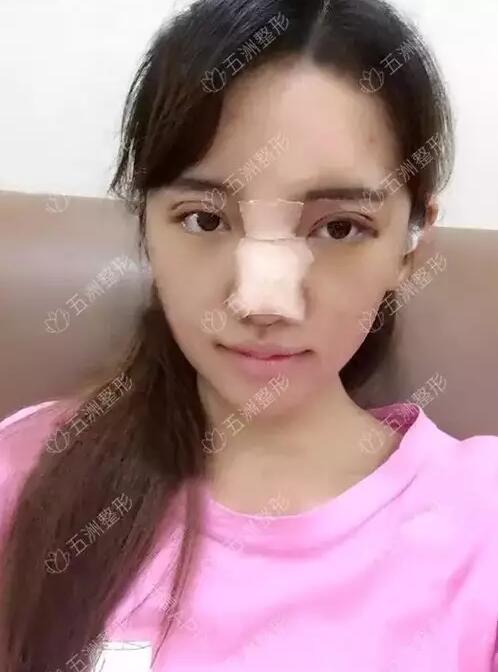 黑脸娃娃的功如何，重庆五洲整形真实案例为你解答