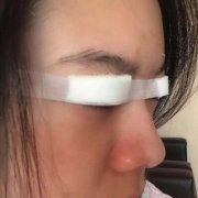 3个月前在成都莱尹做的内眼角修复，术后记录恢复过程~ width=