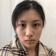八大处祁佐良双眼皮平行扇形案例，单眼皮到自然双眼皮的神奇转变~ width=