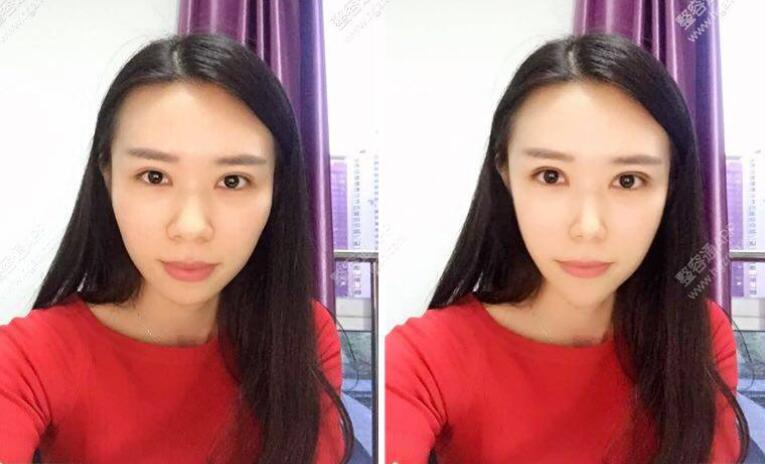 女性不对称下颌角整形
