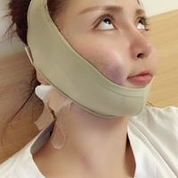 下颌角截骨整形技术如何?内附静蔓整形果图