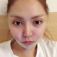 下颌角截骨整形技术如何?内附静蔓整形果图
