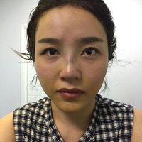 鼻头缩小对比图，真人诠释鼻头缩小后果