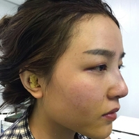 鼻头缩小对比图，真人诠释鼻头缩小后果