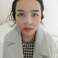 鼻头缩小对比图，真人诠释鼻头缩小后果